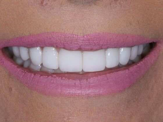 Veneers Cassidy - After