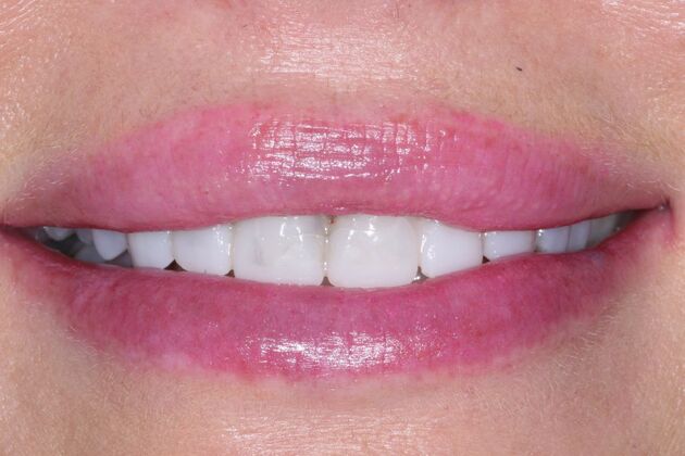 Veneers Amanda - Before