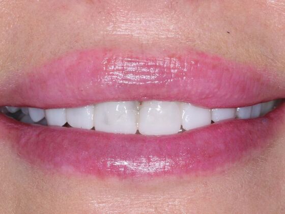 Veneers Amanda - Before