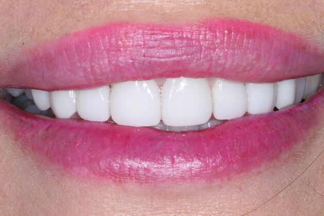 Veneers Amanda - After