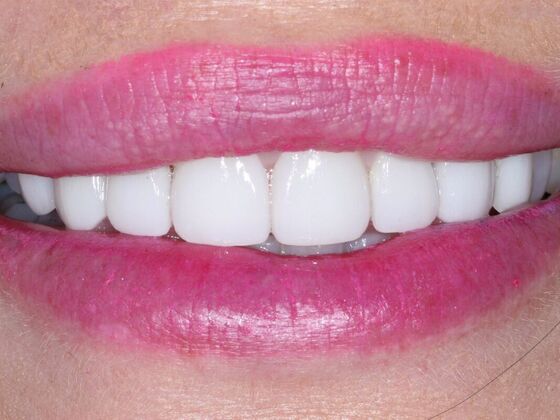 Veneers Amanda - After