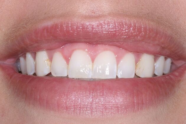 Veneers Alex - Before