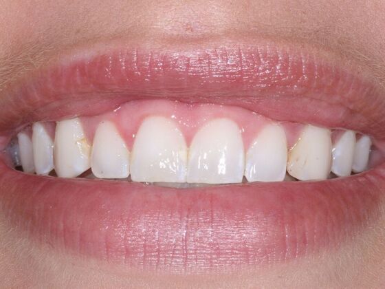 Veneers Alex - Before