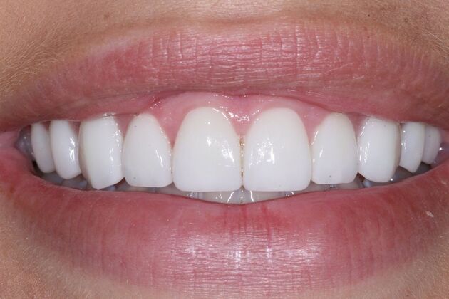Veneers Alex - After