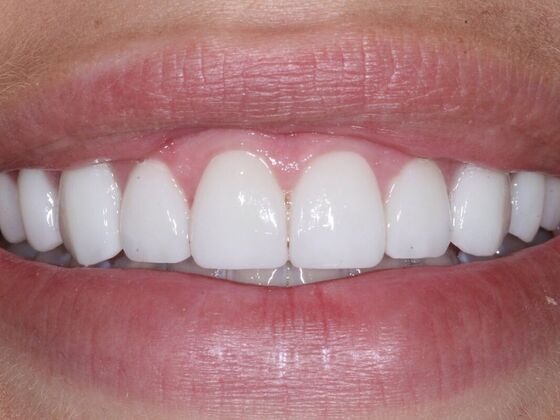 Veneers Alex - After