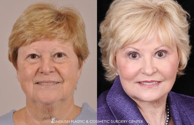 Facelift: Case 32 - Before and After