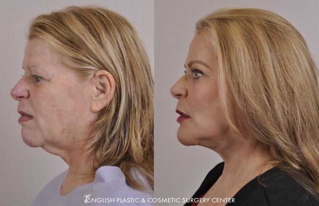 Facelift: Case 29 - Before and After