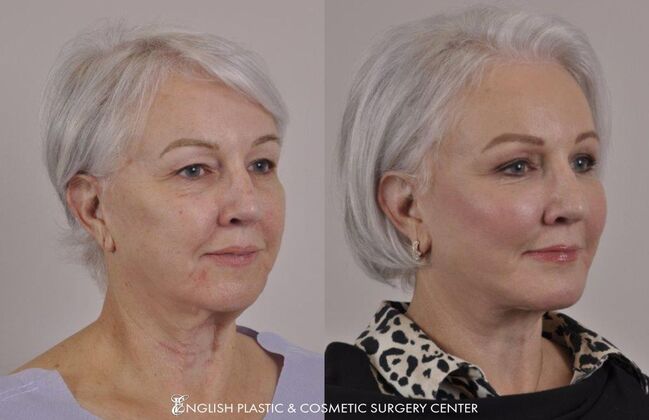 Facelift: Case 19 - Before and After