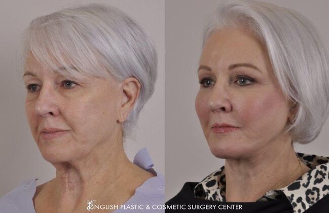 Facelift: Case 19 - Before and After
