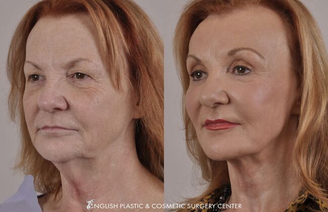 Facelift: Case 9 - Before and After