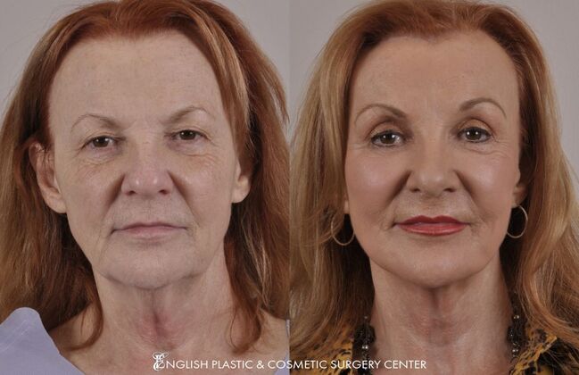 Facelift: Case 9 - Before and After