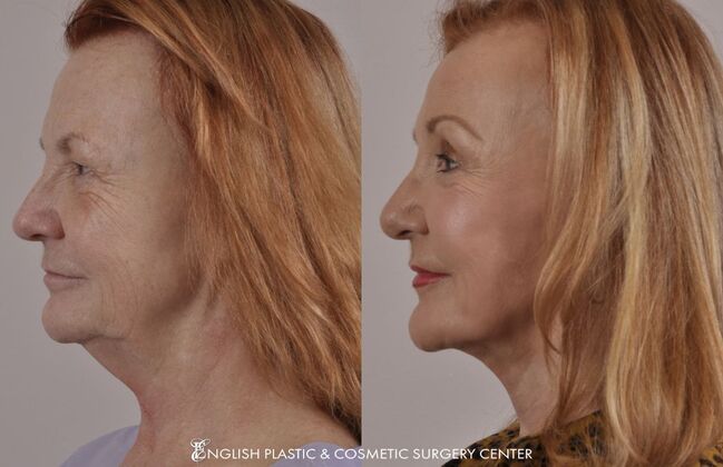 Facelift: Case 9 - Before and After