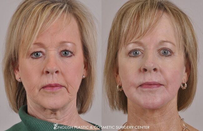Facelift: Case 37 - Before and After