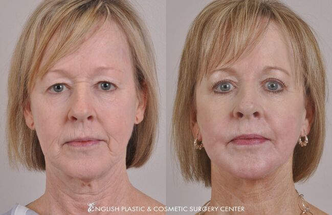 Facelift: Case 37 - Before and After