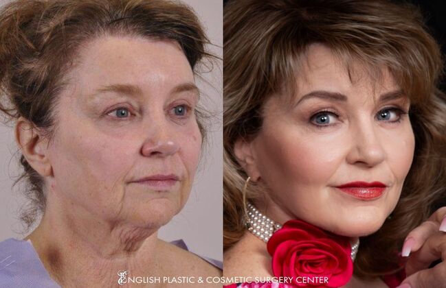 Facelift: Case 1 - Before and After