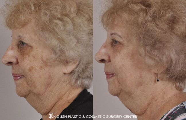 Chemical Peels: Case 5 - Before and After