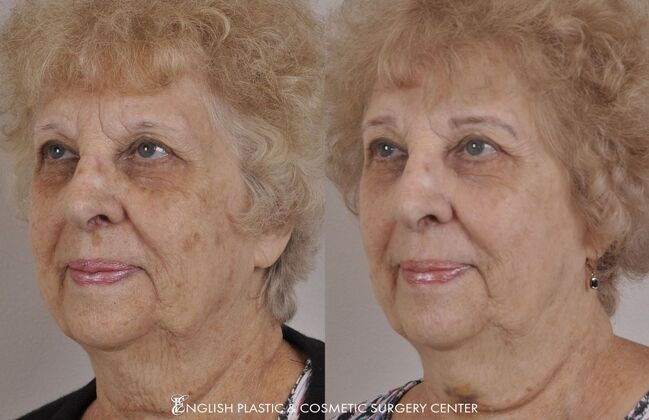 Chemical Peels: Case 5 - Before and After