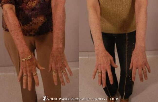 Chemical Peels: Case 6 - Before and After