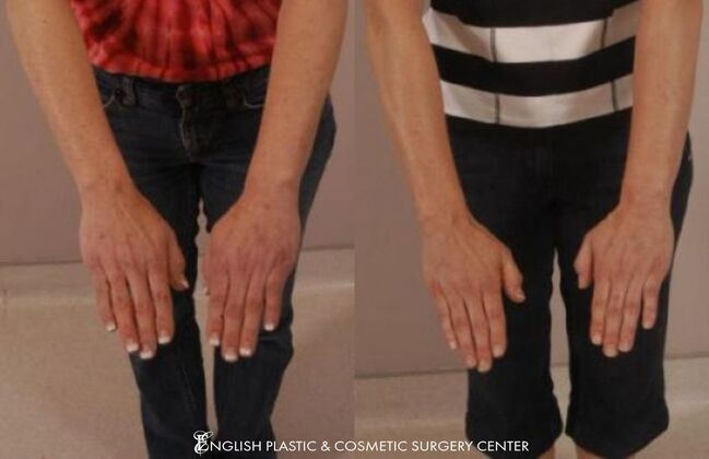 Chemical Peels: Case 7 - Before and After