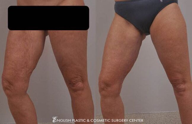 Thigh Lift: Case 1 - Before and After