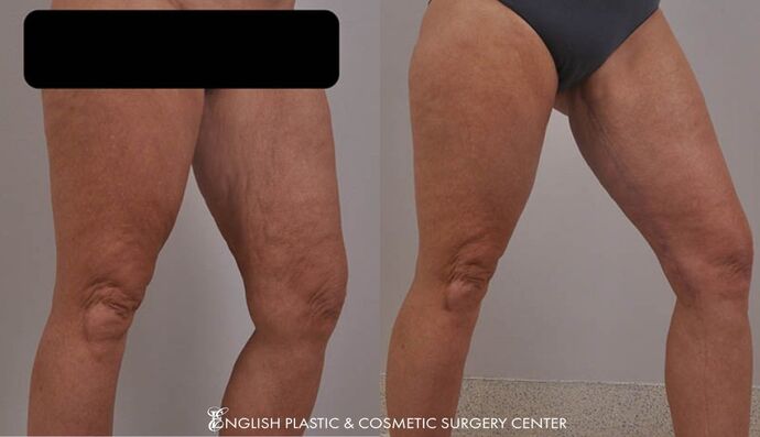 Thigh Lift: Case 1 - Before and After