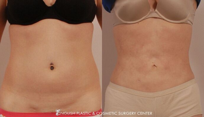 Liposuction: Case 6 - Before and After