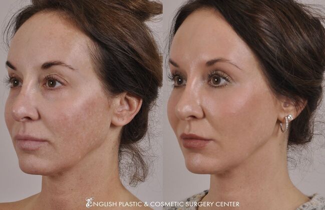 Laser Skin Resurfacing: Case 1 - Before and After