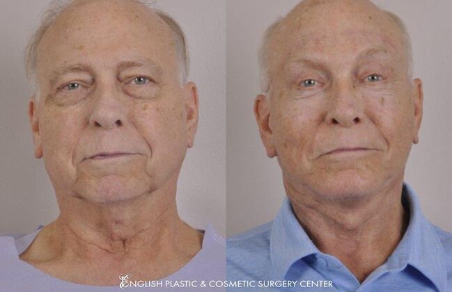 Laser Skin Resurfacing: Case 6 - Before and After