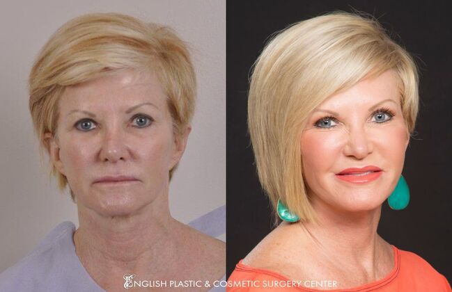 Fillers: Case 1 - Before and After