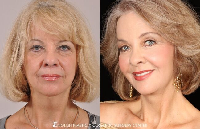 Fillers: Case 11 - Before and After