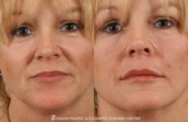 Fillers: Case 12 - Before and After