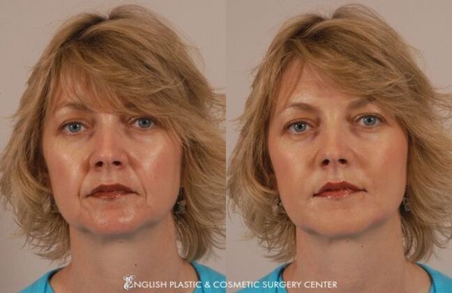 Fillers: Case 9 - Before and After