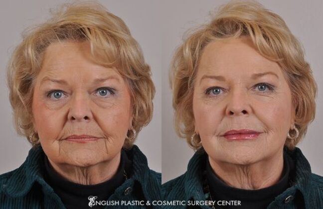 Fillers: Case 3 - Before and After