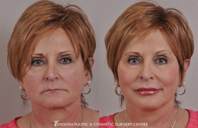 Fillers: Case 10 - Before and After