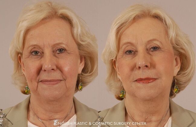Fillers: Case 8 - Before and After