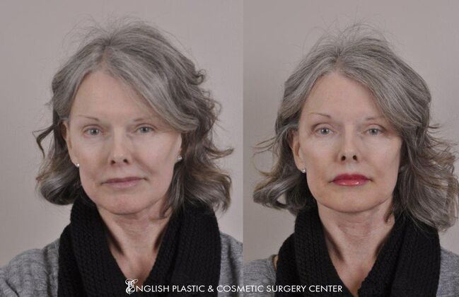 Fillers: Case 5 - Before and After