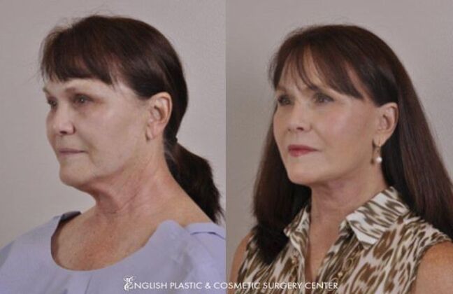 Fillers: Case 7 - Before and After