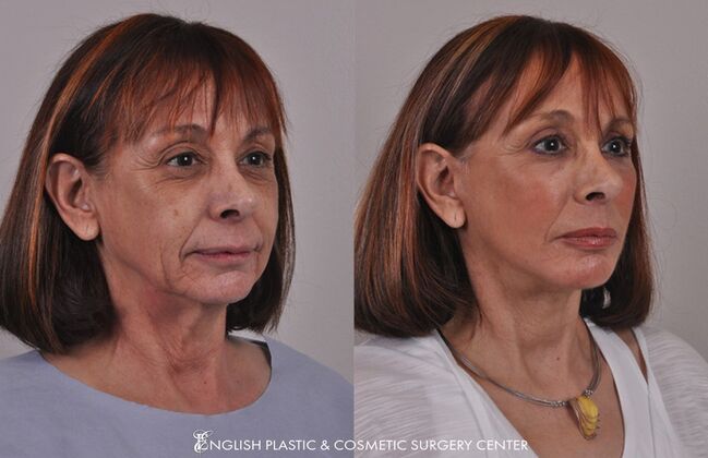 Fillers: Case 6 - Before and After