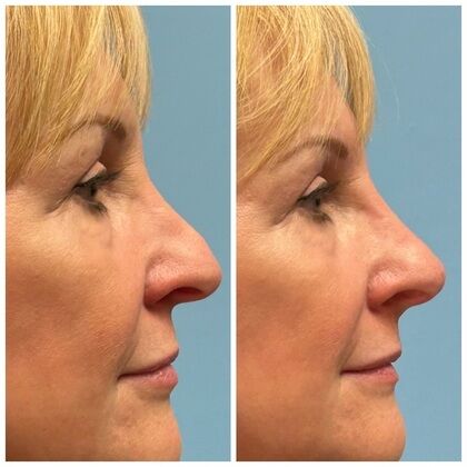 Liquid Rhinoplasty Cases