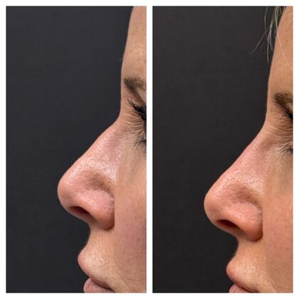 Liquid Rhinoplasty Case 2