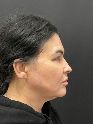 Threadlift Case 2 - Before