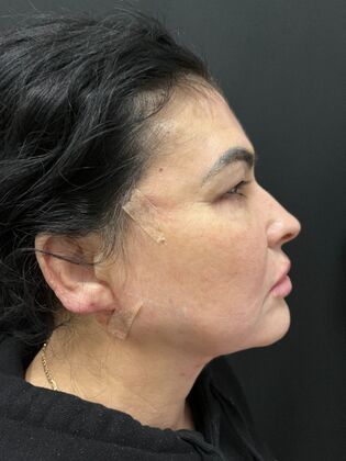 Threadlift Case 2 - After