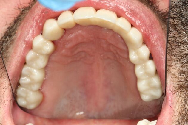 Crowns and Bridges: Case 1 - After