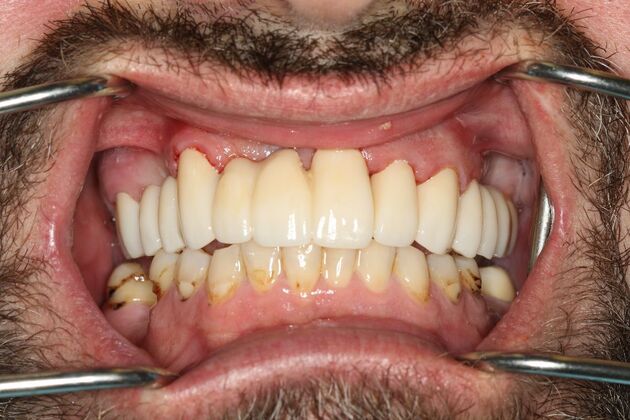 Crowns and Bridges: Case 1 - After