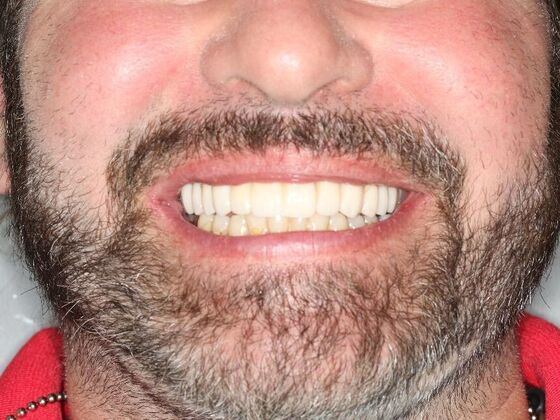 Crowns and Bridges Case