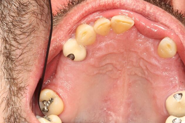 Crowns and Bridges: Case 1 - Before