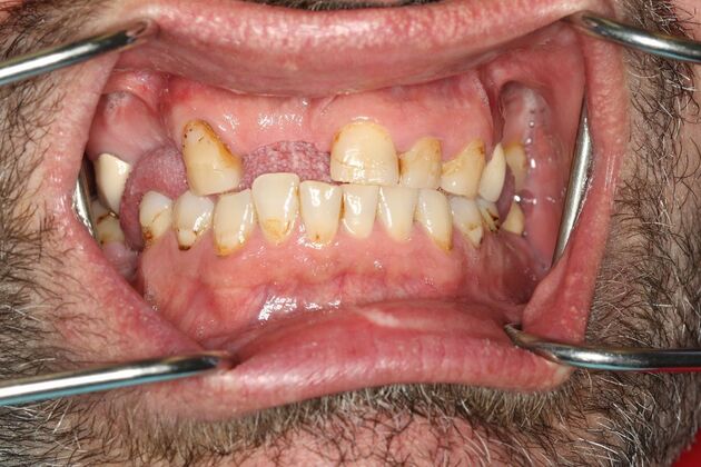 Crowns and Bridges: Case 1 - Before