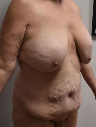 Massive Weight Loss : Case 177 - Before