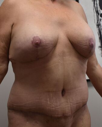 Mommy Makeover Case 342 - After