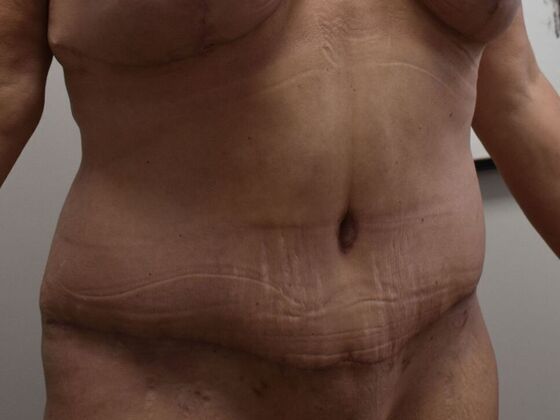 Tummy Tuck (Abdominoplasty): Case 539 - After